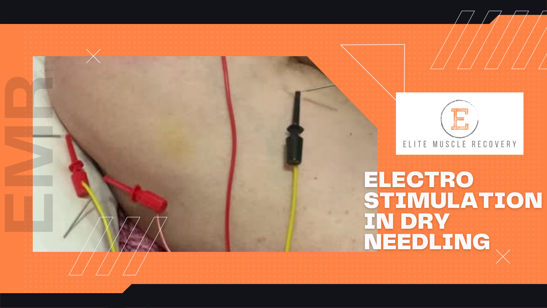 Introducing Electo Stimulation with Dry Needling to kick start your healing
