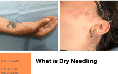 Dry Needling 101